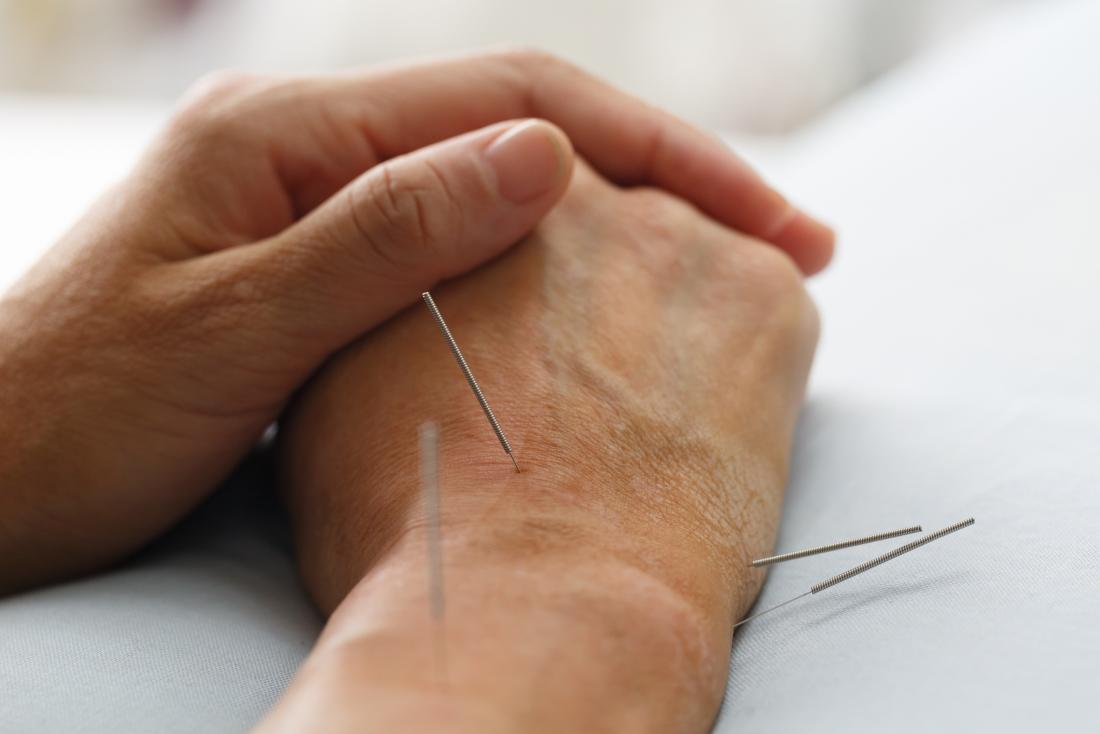 Finding Pain Relief With Acupuncture post thumbnail image