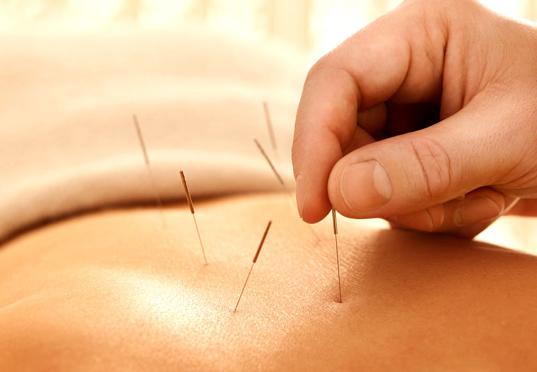 Acupuncture Melbourne Clinics will have Fully Trained and Licensed Acupuncturists post thumbnail image