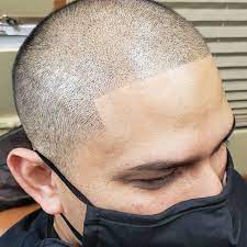 Scalp Micropigmentation – Hair Restoration For Men and Women post thumbnail image