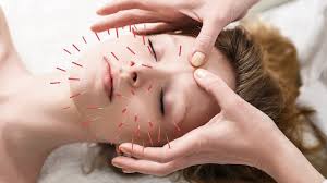 Acupuncture Melbourne – How Acupuncture Can Improve Your Health post thumbnail image