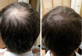 Scalp Micropigmentation is a New Hair Loss Treatment post thumbnail image